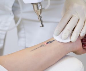 how-does-laser-tattoo-removal-work